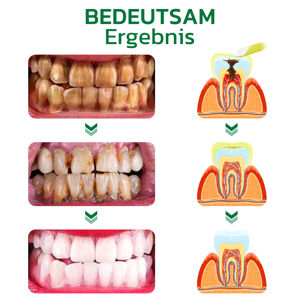 GFOUK™ Perlweiß Pflanzenextrakt Zahnsteinentfernung Ampulle Zahnpasta