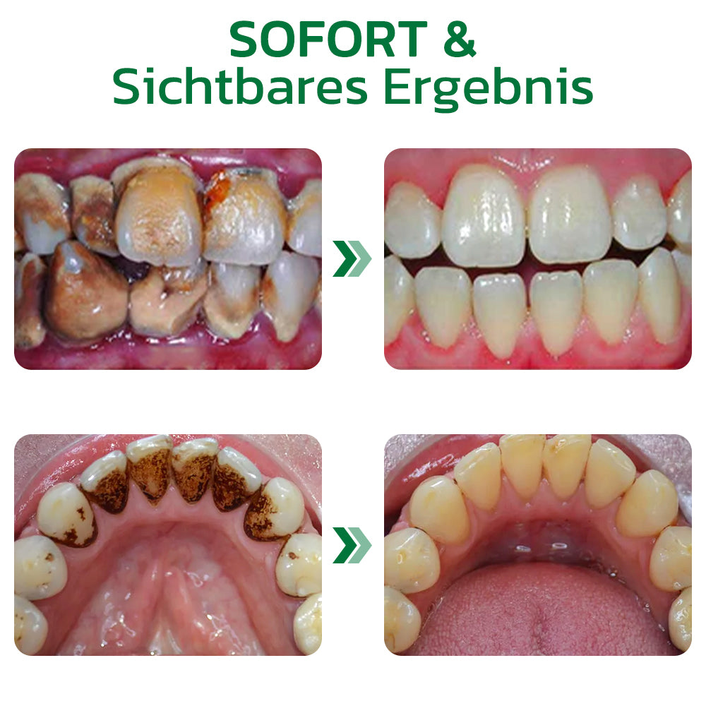 GFOUK™ Perlweiß Pflanzenextrakt Zahnsteinentfernung Ampulle Zahnpasta