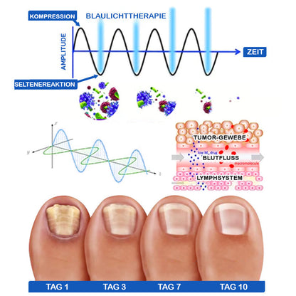 Furzero™ Nagelpilzreinigung Laser Linderungsgerät