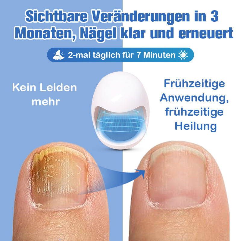 Furzero™ Nagelpilzreinigung Laser Linderungsgerät