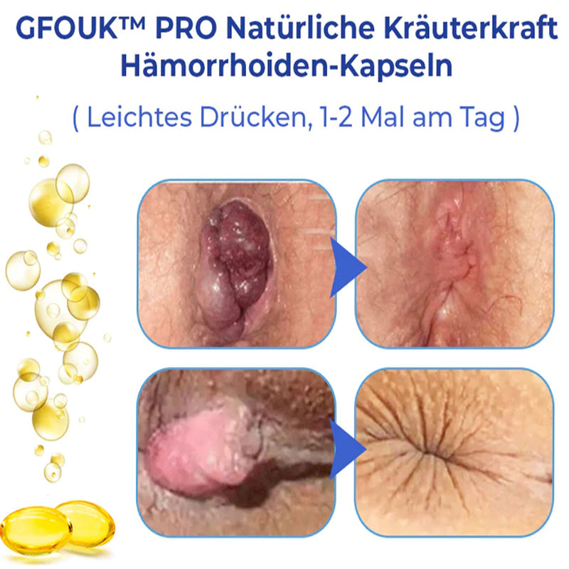 GFOUK™ PRO Natürliche pflanzliche Stärke Hämorrhoiden-Kapseln