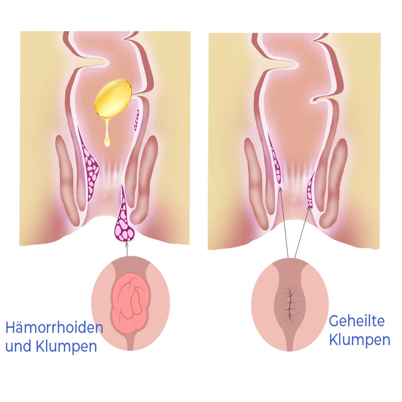 GFOUK™ PRO Natürliche pflanzliche Stärke Hämorrhoiden-Kapseln