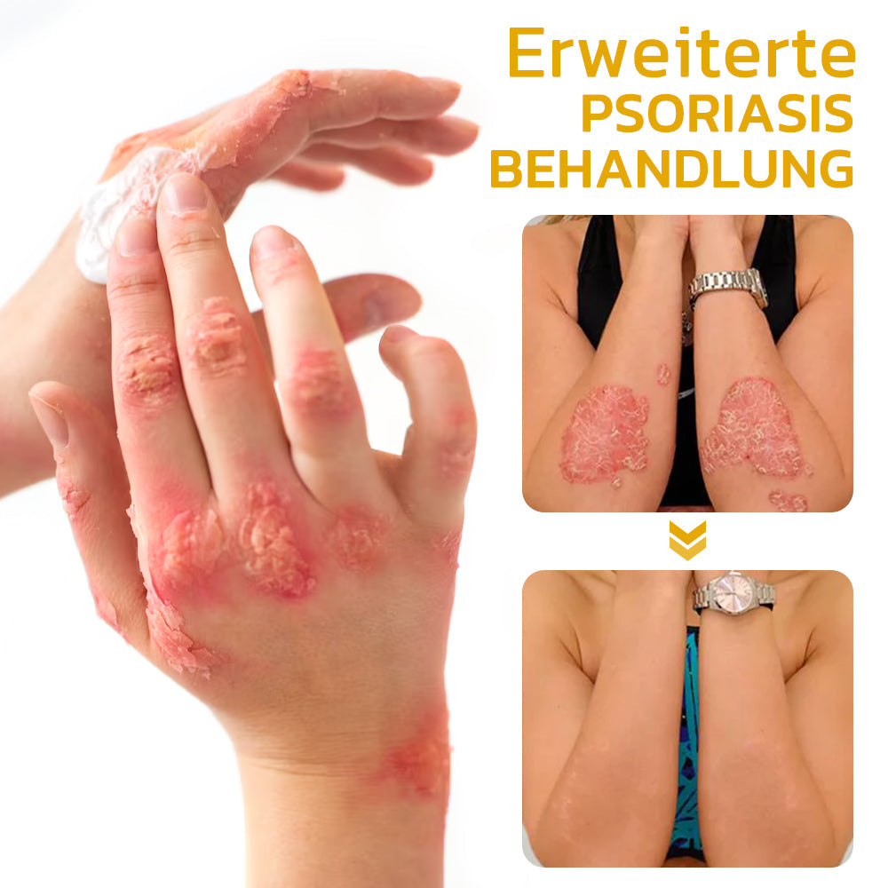 GFOUK™️ Bienengift Schuppenflechte-Behandlungscreme