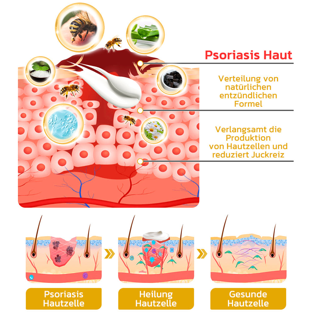 GFOUK™️ Bienengift Schuppenflechte-Behandlungscreme
