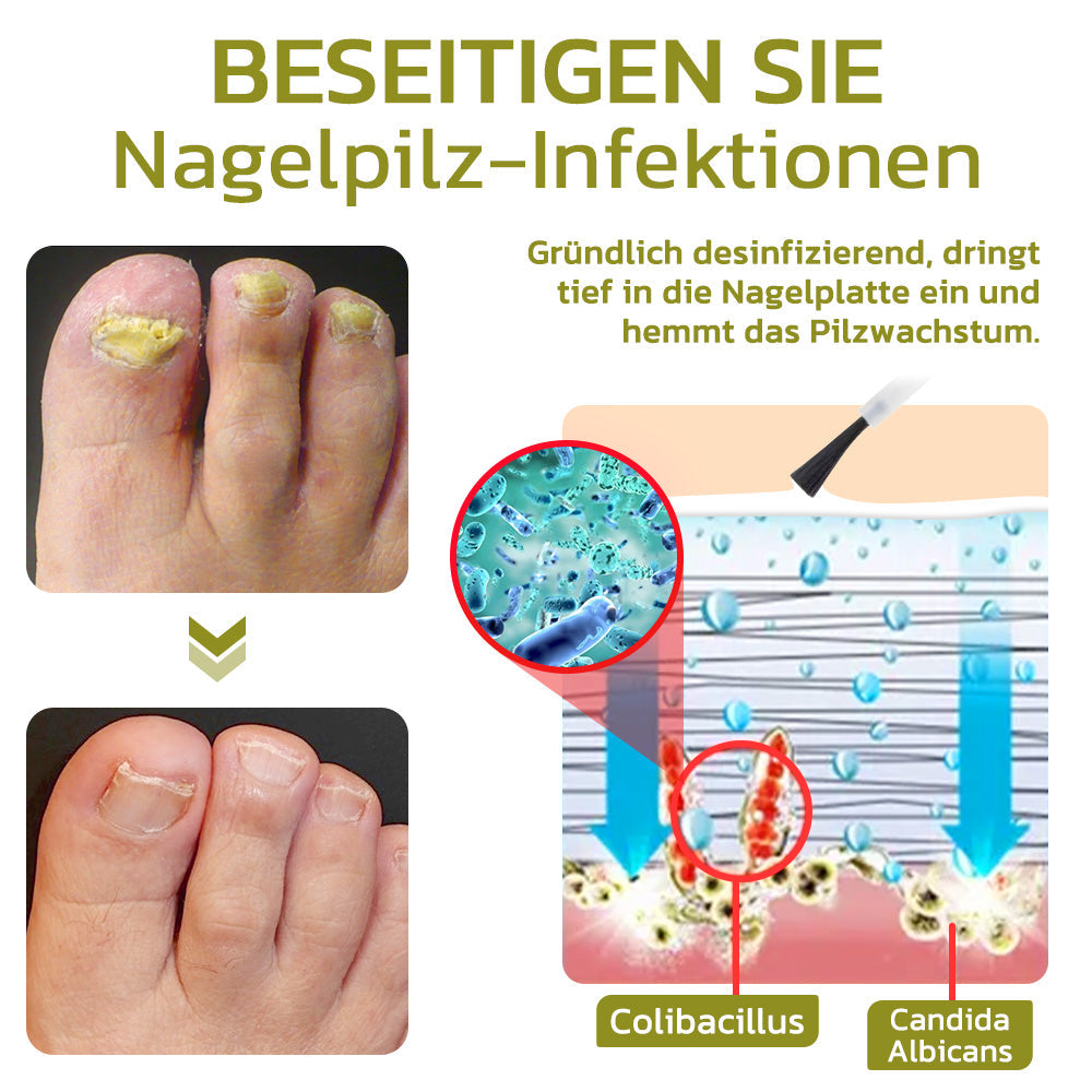 GFOUK™️ Intensives Serum für Nagelwachstum und stärkung