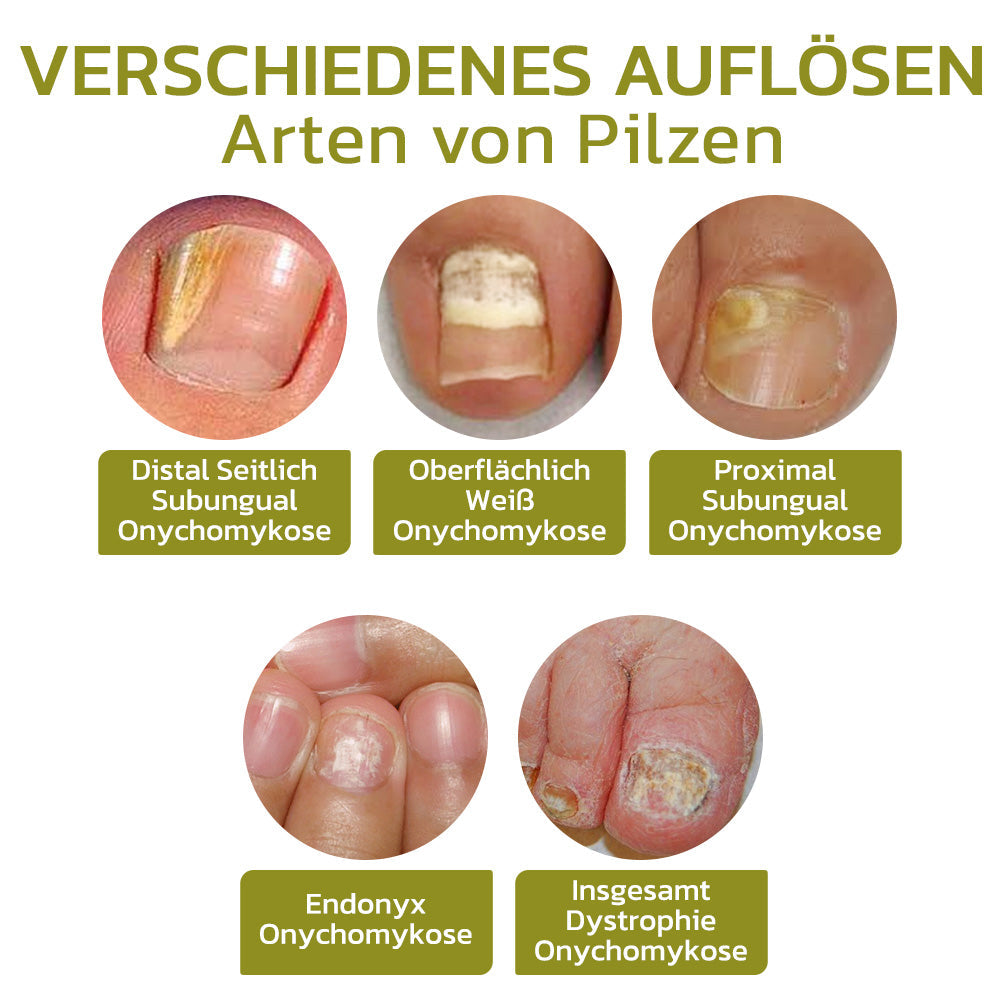 GFOUK™️ Intensives Serum für Nagelwachstum und stärkung