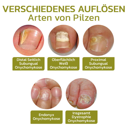 GFOUK™️ Intensives Serum für Nagelwachstum und stärkung