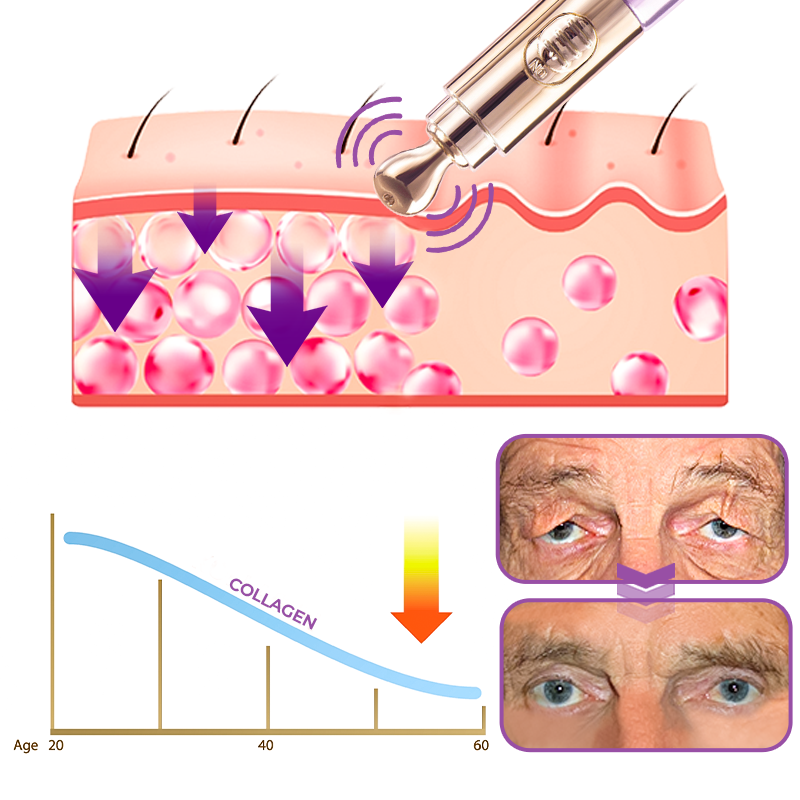 GFOUK™️ Milchflecken-Therapie Elektrischer Serum-Stif