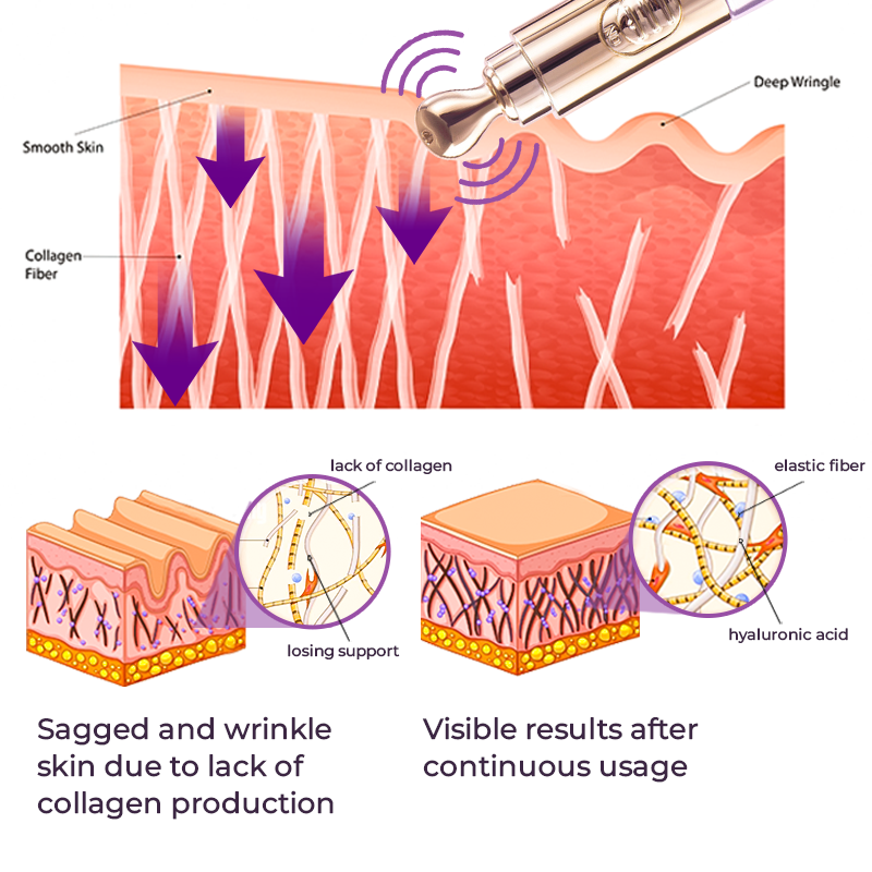 GFOUK™️ Milchflecken-Therapie Elektrischer Serum-Stif