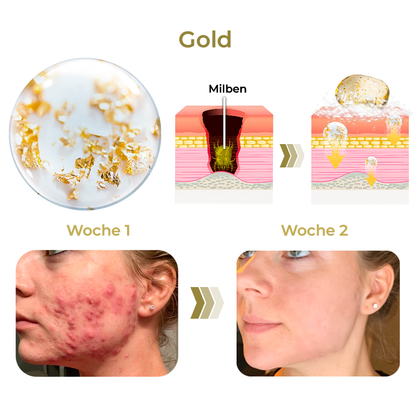 GFOUK™ AcneVe Anti-Milben Goldfolienseife