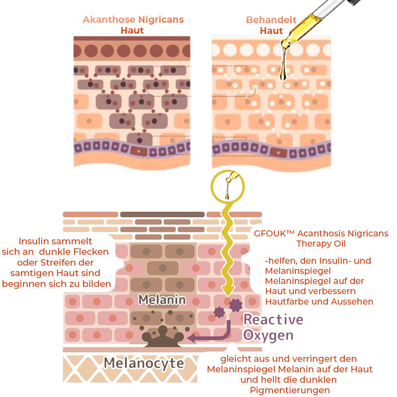 GFOUK™ Akanthose Nigricans Therapie-Öl