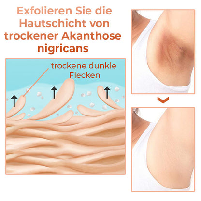 GFOUK™ Akanthose Nigricans Therapie-Öl