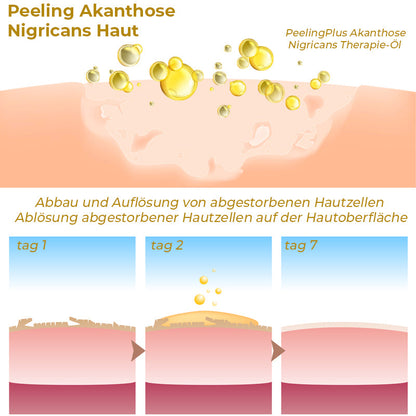 GFOUK™ PeelingPlus Acanthosis Nigricans Therapie-Öl