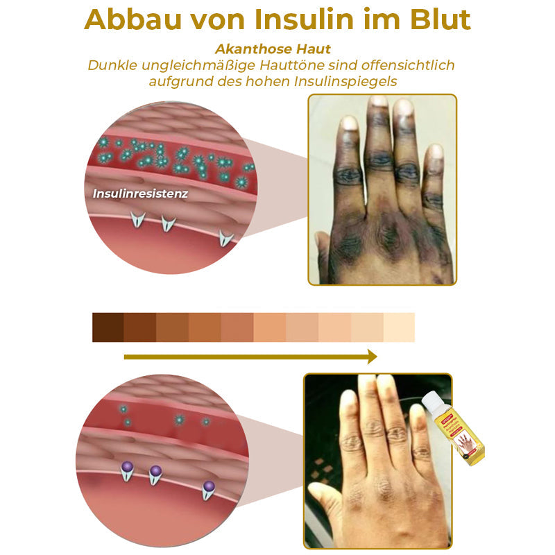 GFOUK™ PeelingPlus Acanthosis Nigricans Therapie-Öl