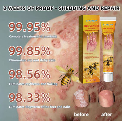 GFOUK™ Bienengift Psoriasis Lindernde Creme